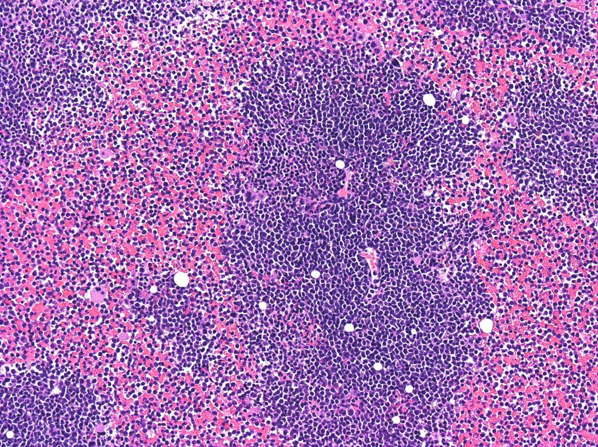 Bone marrow clot shows same findings as biopsy